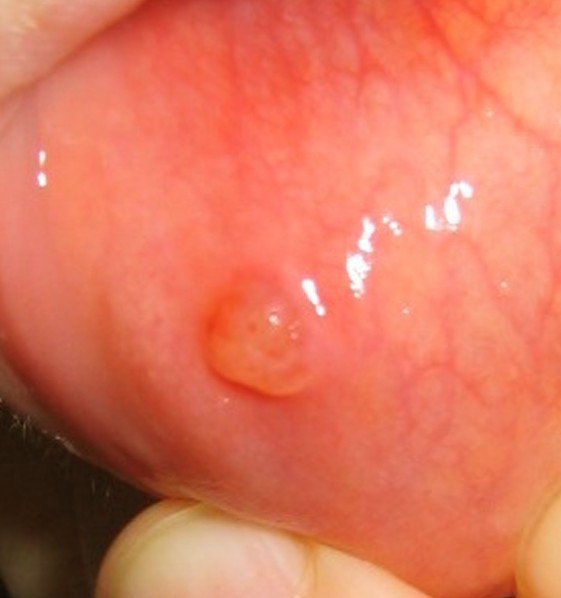 Black Bump Inside Mouth 90