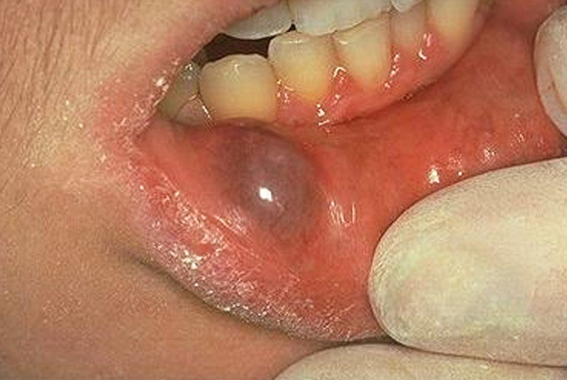 Lump In Mouth Lip 101