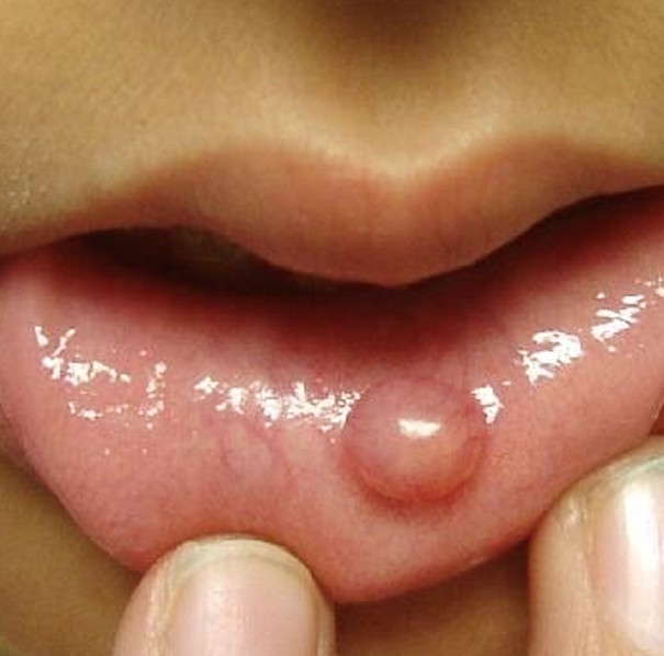 Lump on the inside of my lower lip ?? - Dermatology - MedHelp