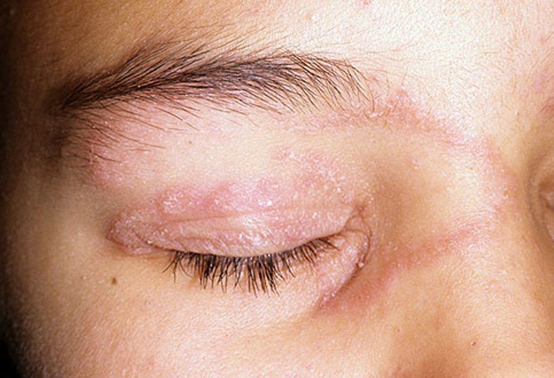 What Causes Dark Dry Patches On Skin