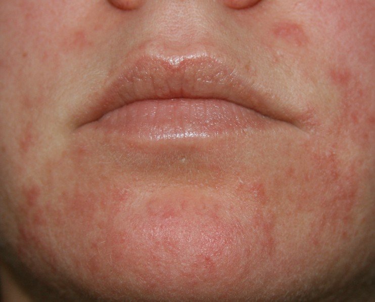 Red Dry Spots On Face And Neck