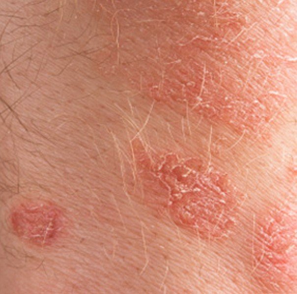 rough-skin-patch-on-chest-lasopalatin