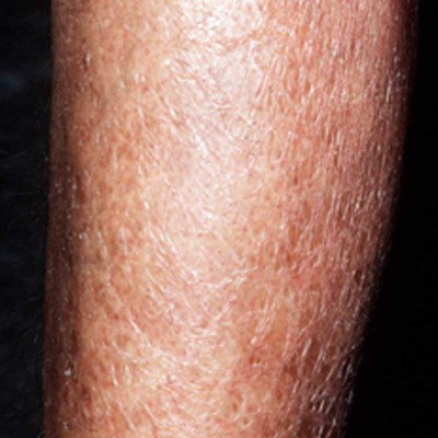 dry skin rash on legs #9