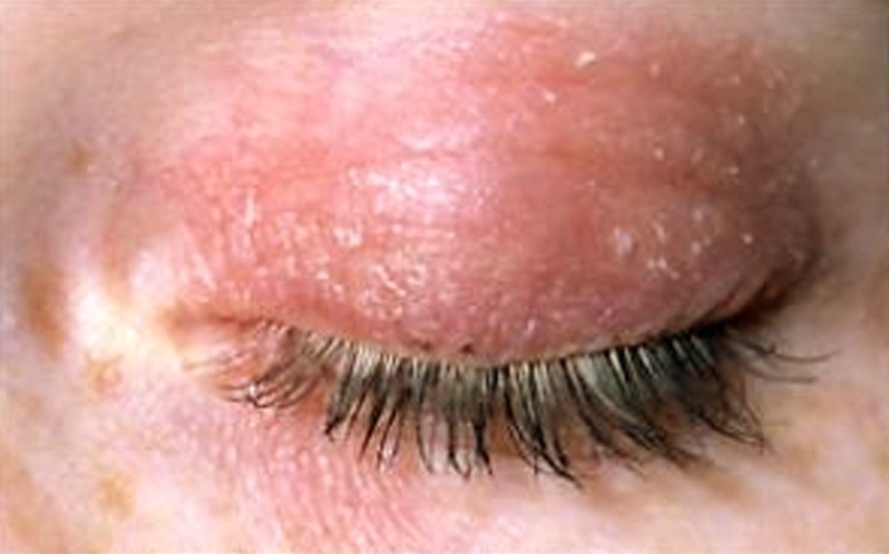 Dry Skin Patches on My Eyelids - Acner.org