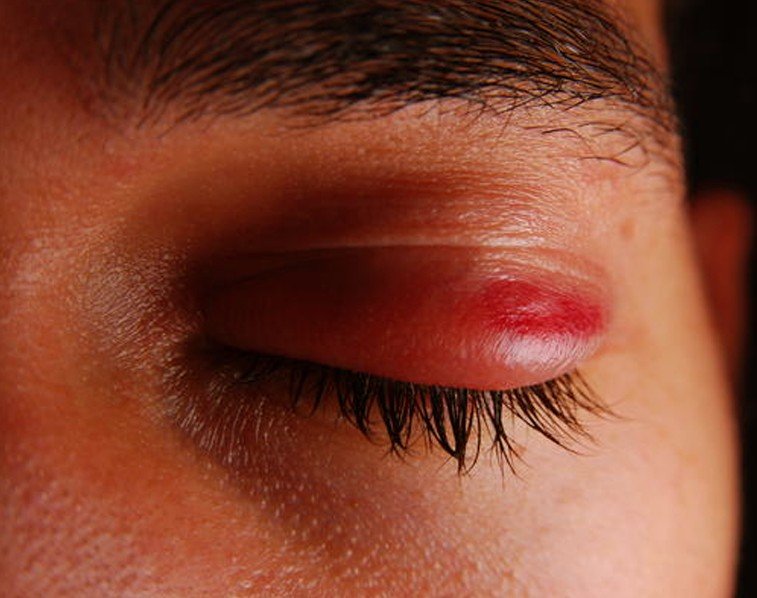 red on eyelid - pictures, photos