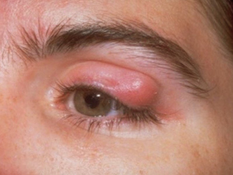 eyelid infected