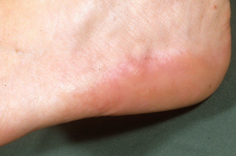 piezogenic pedal papules