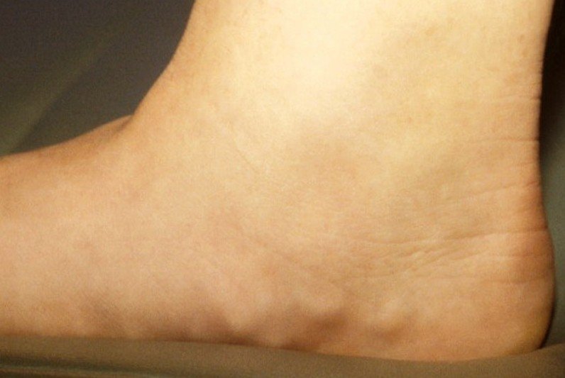 What Are Causes Of Pedal Edema X Ray