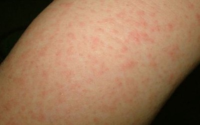 fever and rash in adult - Dermatology - MedHelp