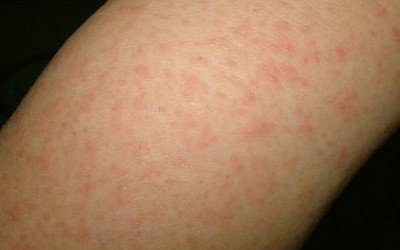 Fever Rash Adult 49