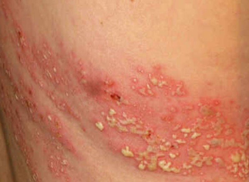 What causes a shingles recurrence?