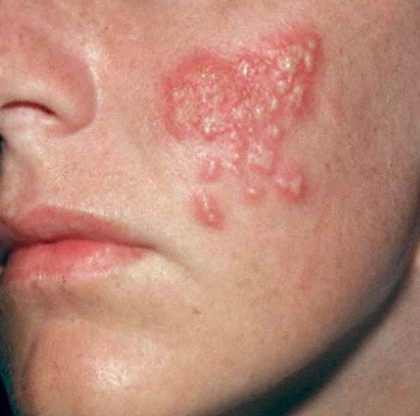 mild erythema #10