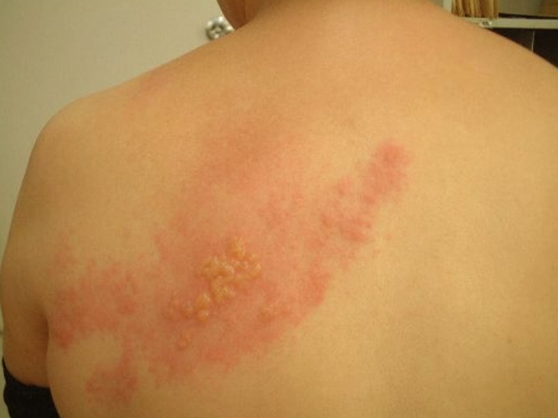 recurrent shingles pictures 7