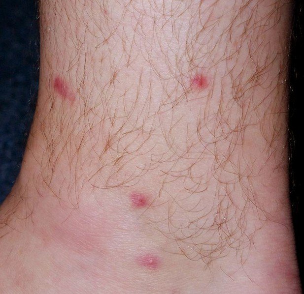 tiny red spots on legs #9