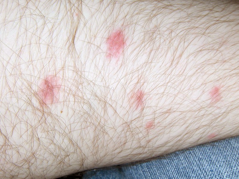 big red bumps on legs that itch