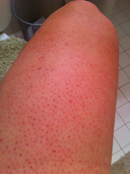 Little red dots on my legs? | Yahoo Answers