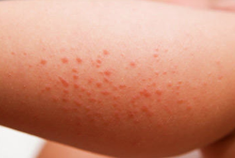 Scabies : Symptoms, treatment and causes - NetDoctor