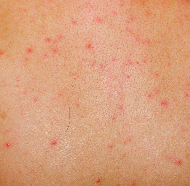 tiny pinpoint red dots on skin