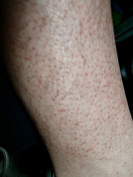 Red Spots On Legs Pictures Symptoms Causes Treatment