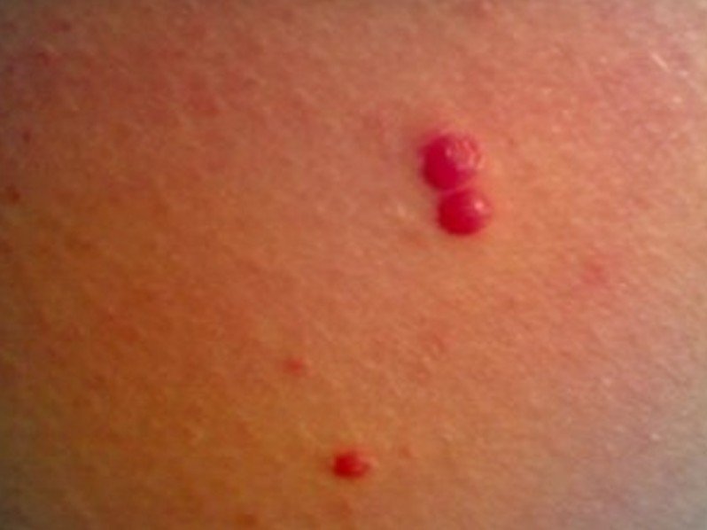 Red Moles on the Skin - Diagnosis & Removal - Amoils.com