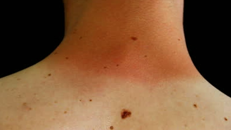 What Causes Red Moles on Your Skin - OneHowto