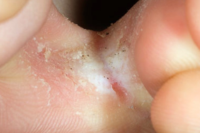 Fungus Between Toes : Treatment For Fungal Infection
