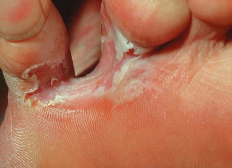 dry skin in between toes