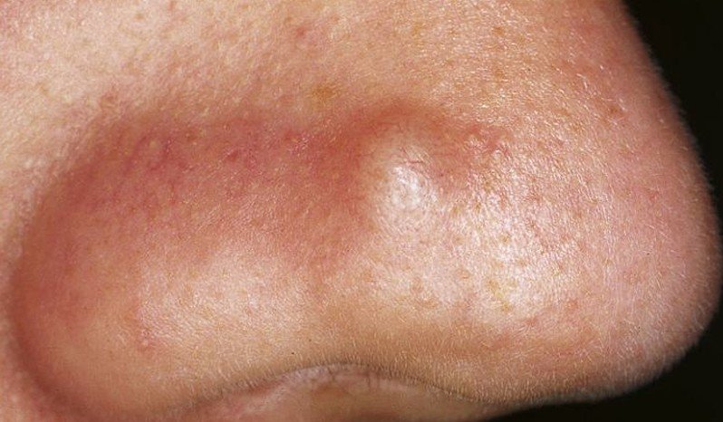 Staph Infection and Cellulitis - WebMD