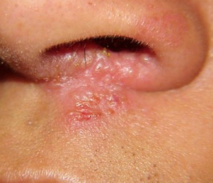 staph infection image #10