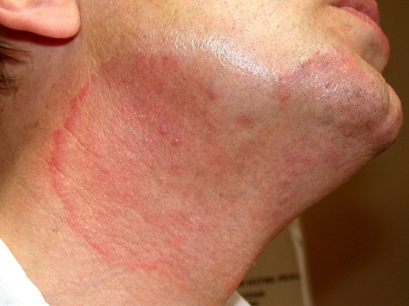 Tinea Versicolor: Cause, Symptoms, and Treatments