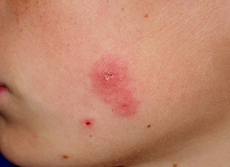 Tinea (Ringworm) Face Photos - Dermatology Education