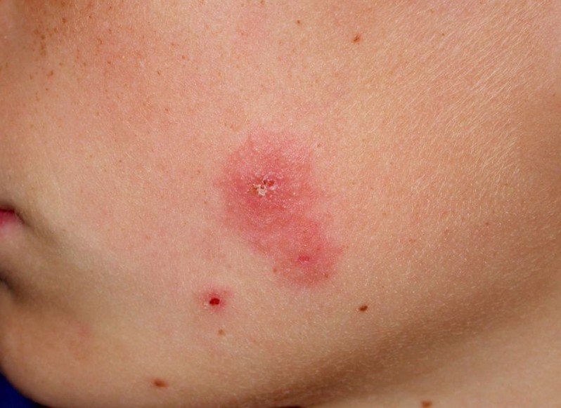 Tinea On Face Pictures Photos