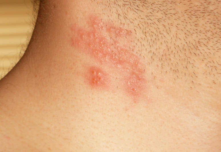 Herpes Skin Rash - Buzzle