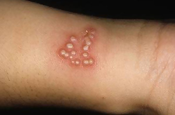 Herpetic whitlow - Wikipedia