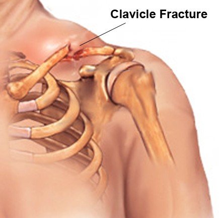 clavicle fracture