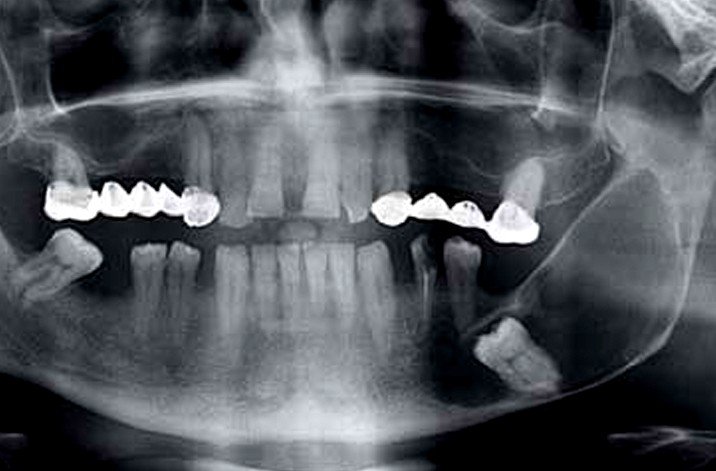 dentigerous cyst