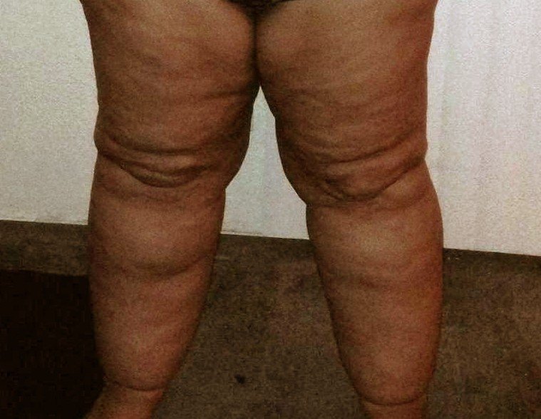 Lipedema - Pictures, Treatment, Diet, Symptoms, Natural Cure