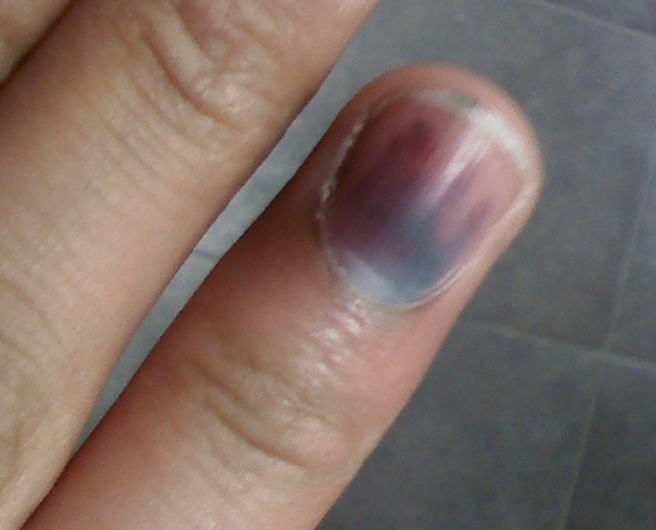 melanoma under fingernail