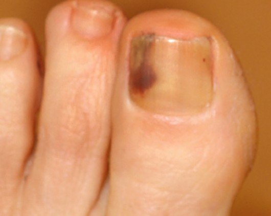 melanoma-under-nail-bed-photos-nail-ftempo