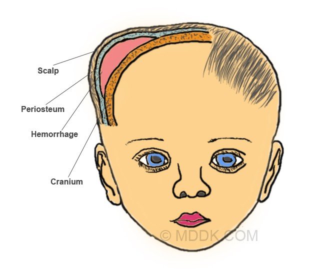 cephalohematoma