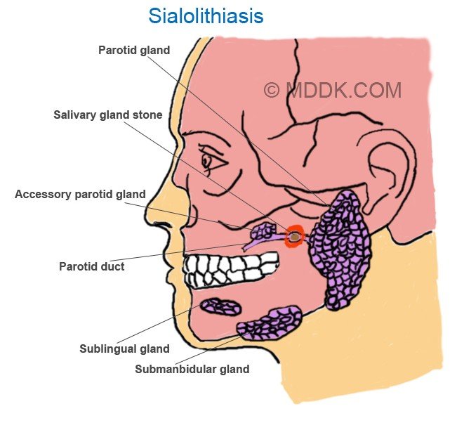 sialolithiasis