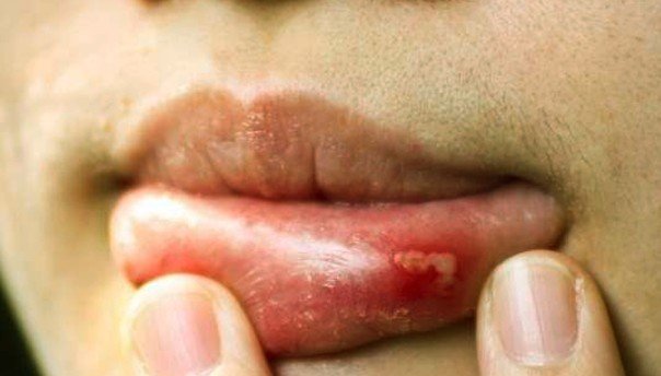 canker sore on lip