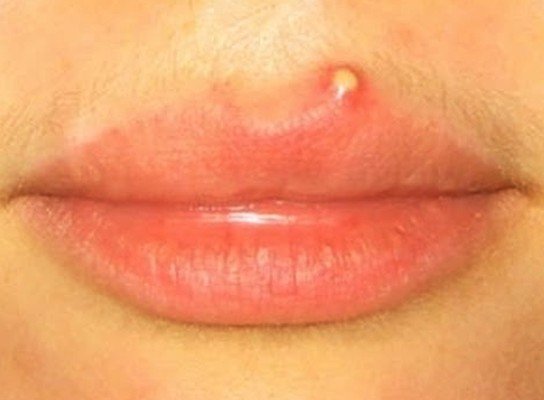 Cold sore (herpes simplex virus) - NHS Choices