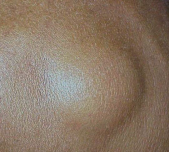 angiolipoma pictures