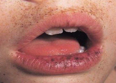 black spots on lips pictures