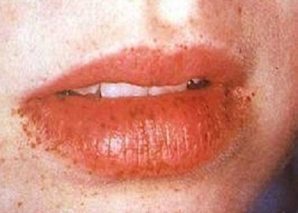 black spots on lips