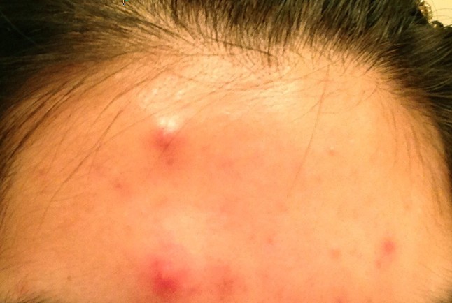 painful pimple