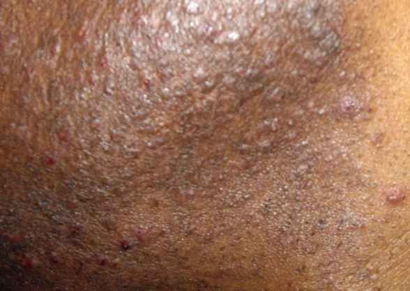 What is an infected hair follicle?