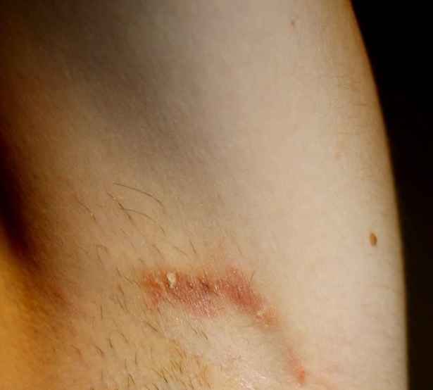 Underarm rash - RightDiagnosis.com