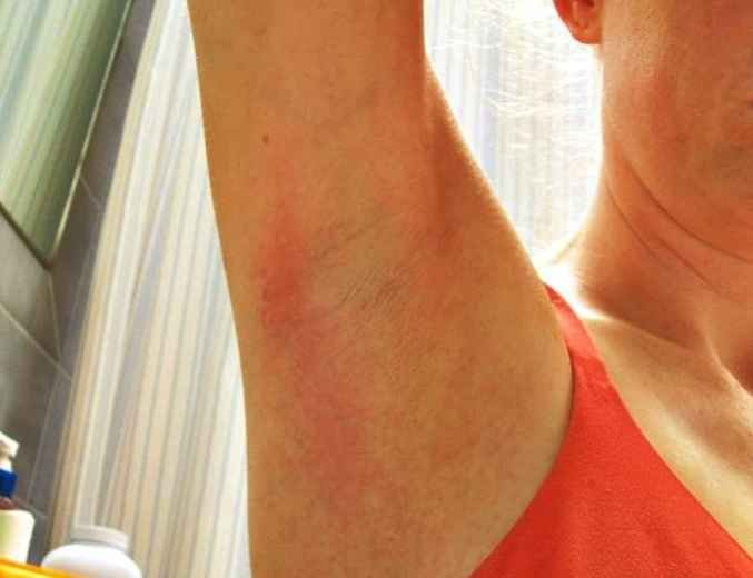 staph rashes #11